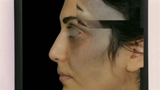 درمان خال مادرزادی