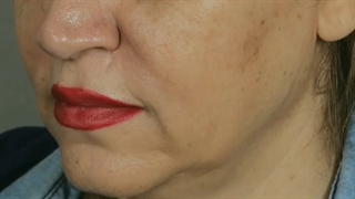 لیفت صورت با نخ