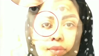 لیفت دایرکت ابرو توسط فوق تخصص پلاستیک- کلینیک vip تهران