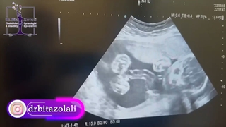 سونوگرافی جنین 6 ماهه