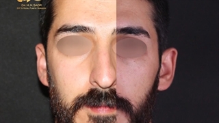 جراحی بینی مردانه, با نتیجه ی عالی!