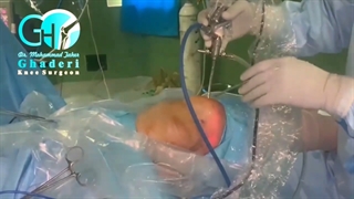 جراحی لیزری زانو چگونه ست؟