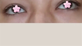 کانتوپلاستی