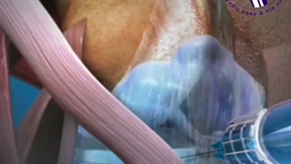 درمان غیرجراحی آرتروز زانو