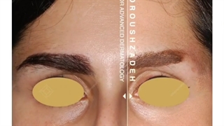 کاشت ابروی طبیعی