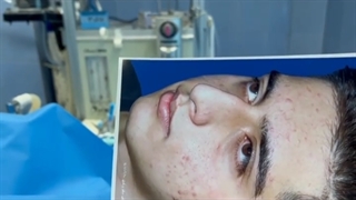 جراحی بینی مردانه