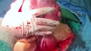 فیلم جراحی فیبروم خیلی بزرگ!