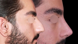 جراحی بینی مردانه