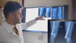 جوش نخوردگی استخوان