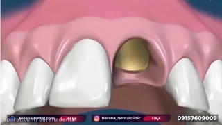 مراحل ایمپلنت دندان به همراه پیوند استخوان