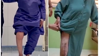 تعویض مفصل زانو