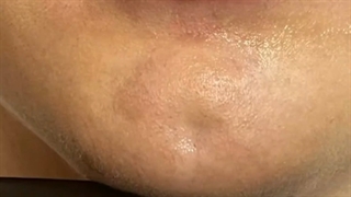 تزریق فیلر چانه