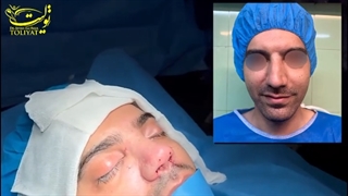 نمونه ای از جراحی رینوپلاستی مردانه