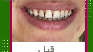 کامپوزیت دندان