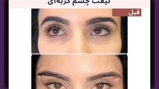 لیفت چشم گربه ای