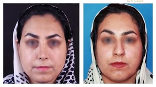 ۱۰ماه بعد از عمل بینی چه شکلیه؟