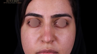 عکس واقعی جراحی بینی