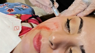میکرونیدلینگ صورت لیپوساکشن