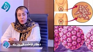 راهکار مقابله ای با زگیل  تناسلی