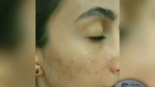 کرم ضد لک و ضد چروک هشتکاره شمعدانی سفارش09307037521 مزوتراپی