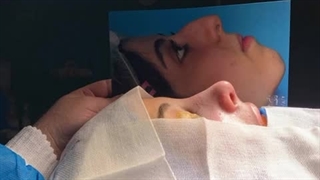 جراحی بینی قوس دار