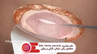 زایمان سزارین