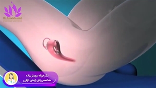 نکاتی درباره آی یو دی