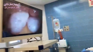 درمان ناباروری با لاپاراسکوپی