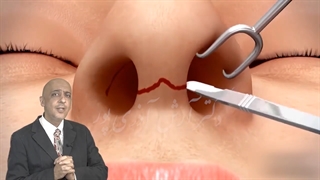 راینو پلاستی بعد از جراحی فک