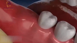 جراحی دندان عقل در اتاق عمل