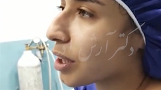 راینوپلاستی