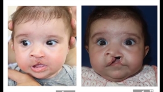 درمان شکاف لب مادرزادی