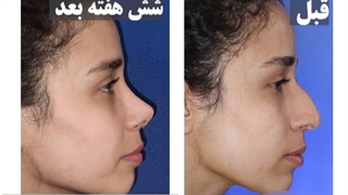 راینوپلاستی