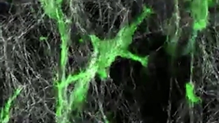 تهاجم سلول های سرطان پستان در بافت واقعی