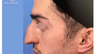 جراحی زیبایی بینی