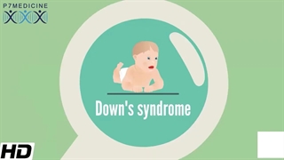 درمان و تشخیص سندرم داون