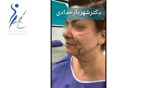 رضایت عزیزانم،لیفت صورت