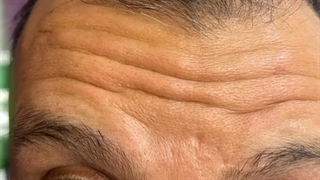 بوتاکس پیشانی