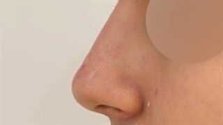 تغییرات قبل و بعد بینی بدون جراحی!