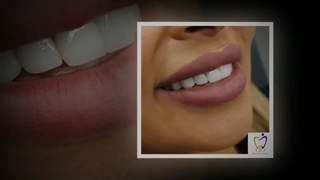 اصلاح طرح لبخند