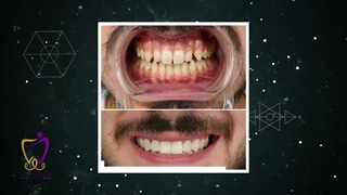 اصلاح طرح لبخند