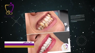 اصلاح طرح لبخند
