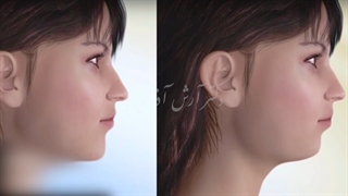 جراحی استخوان چانه یا جنیوپلاستی