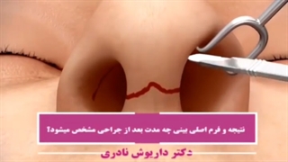 برای مشاهده فرم اصلی بینی بعد از جراحی بینی چه مدت زمان لازم است ؟ .