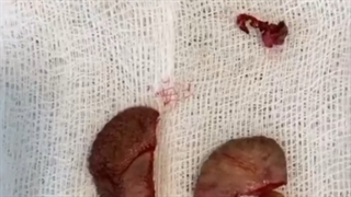 عمل لابیاپلاستی از اعمال سبک و راحت محسوب میشه و عوارضی نداره