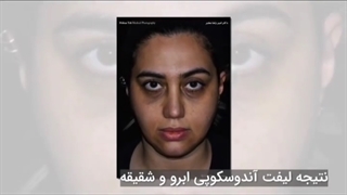 لیفت آندوسکوپی صورت