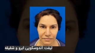لیفت آندوسکوپی