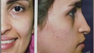 جراحی بینی غضروفی با افتادگی نوک بینی