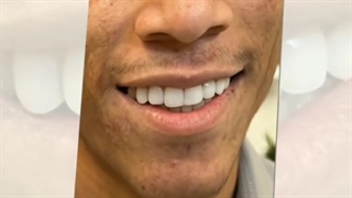 لبخند هالیودی