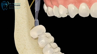 جراحی دندان عقل چگونه است ؟